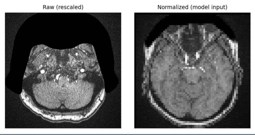 Detection and Localization of Intracranial Aneurysms (Kaggle / RSNA)