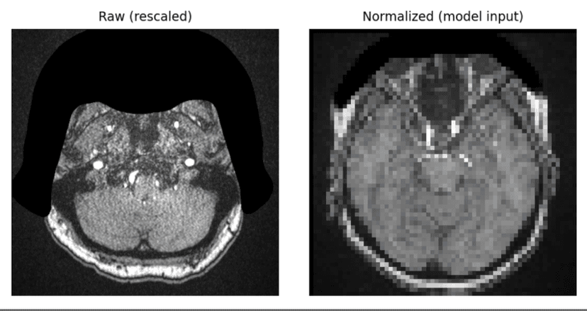 Detection and Localization of Intracranial Aneurysms (Kaggle / RSNA)